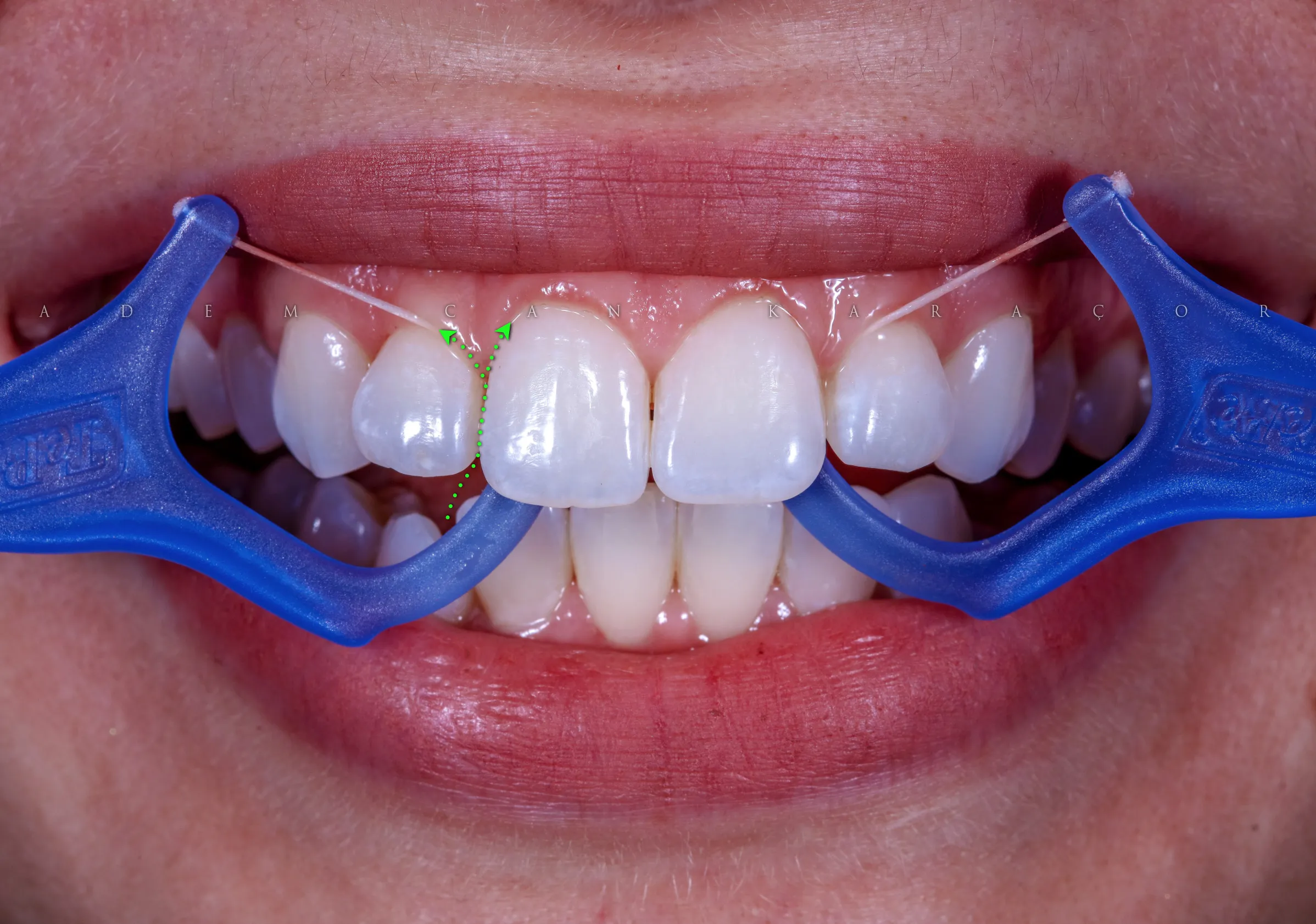 Kürdanlı Diş İpi